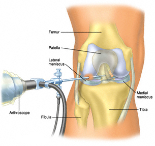 Knee replacement
