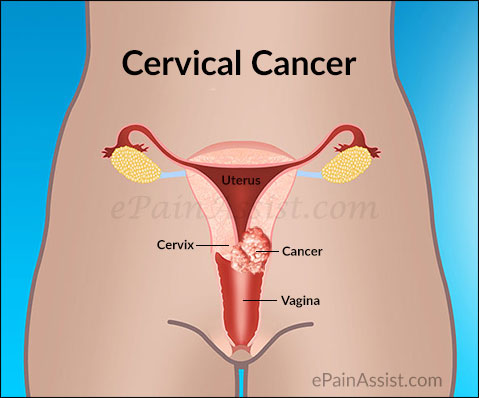 Cervical cancer most top killer among women