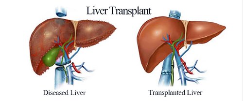 Ram Manohar Lohia Hospital prepares for Liver transplant by next year after 9 years of Kidney transplant