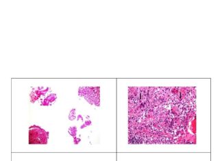 India reports Cytomegalovirus in COVID patients at Sirgangarm Hospital