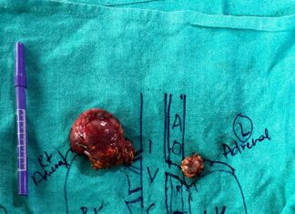 Rare and Complex Surgeries of Adernal Glands performed in Capitals’ Sir Gangaram Hospital Tumor treated in adrenal gland SGH-HealthLive