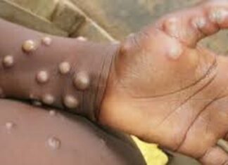Monkey Pox: Disease spread in 70 countries, India is on alert