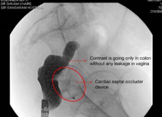 Innovative Endoscopic Surgery Rescues Abnormal Connection Between Intestine and Womb at Sir Ganga Ram Hospital
